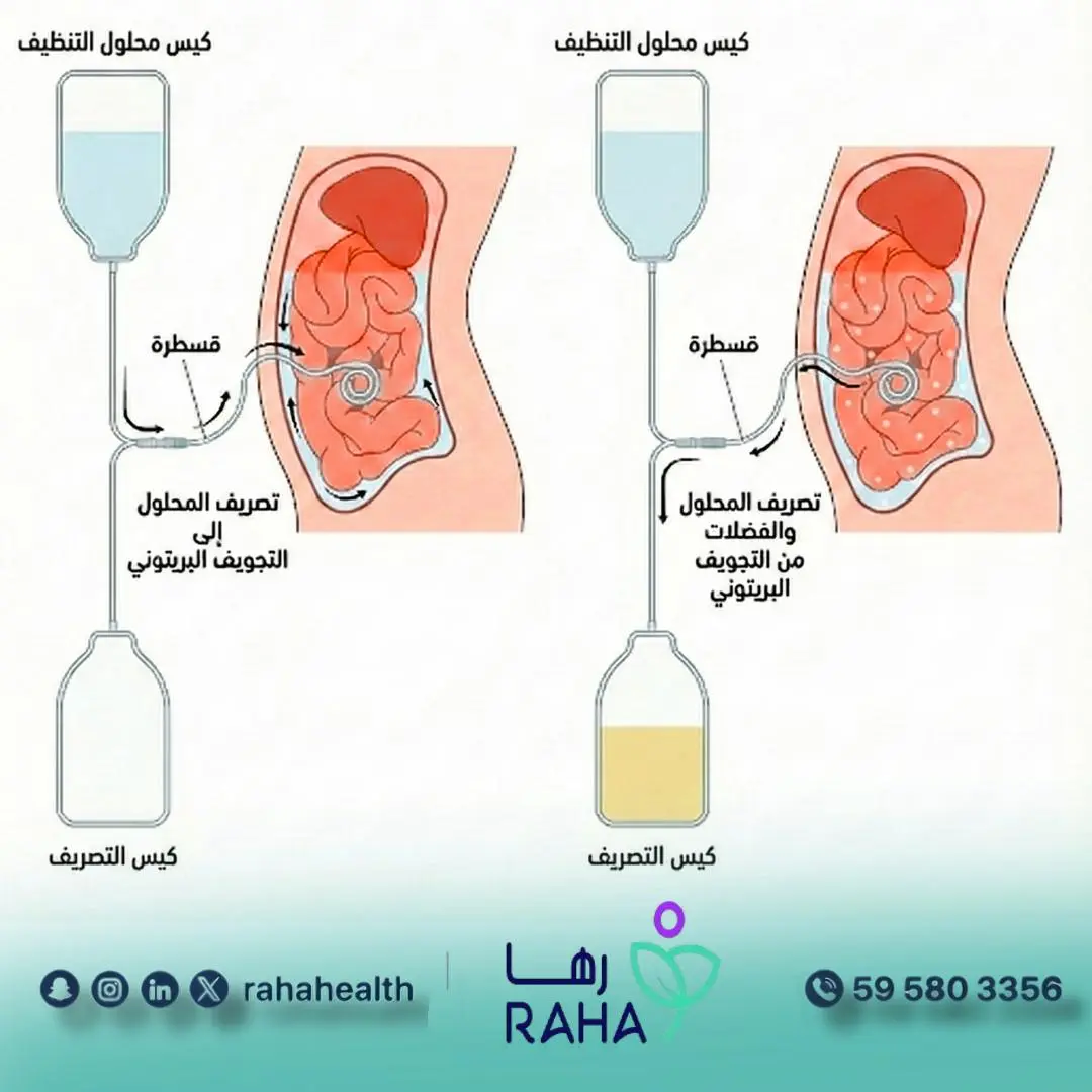 ما هو غسيل الكلى المنزلي؟